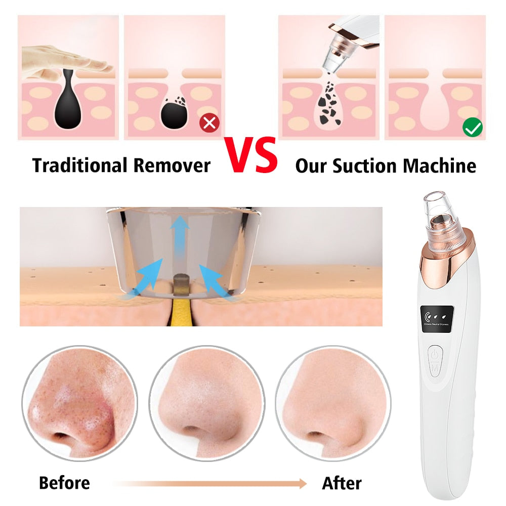 Vacuum Electric Blackhead Remover - GOGO FLEEK